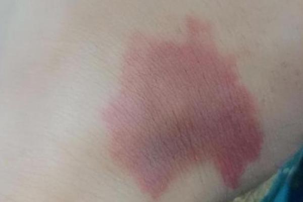 胳膊胎记可以算命吗-
