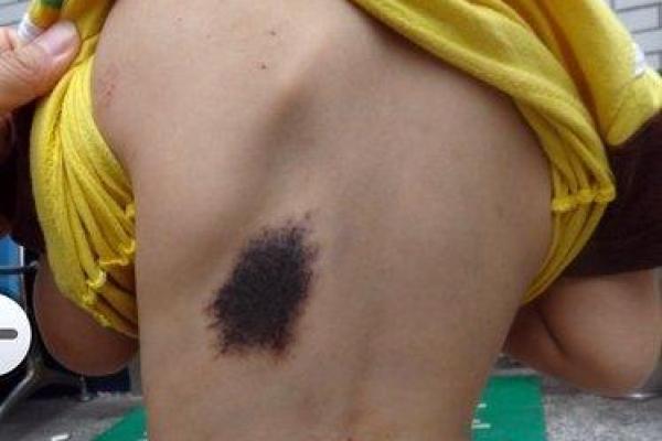 全面解析：胎记算命图解
