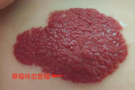 风水胎记胎记是红色的好吗危害