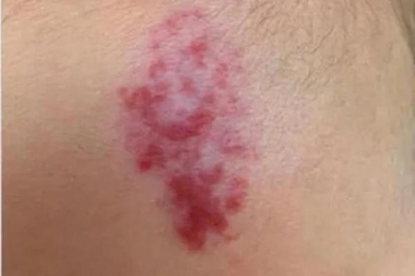 额头长胎记算命一生