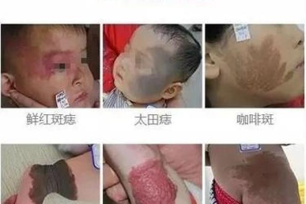 胎记算命的位置与命运