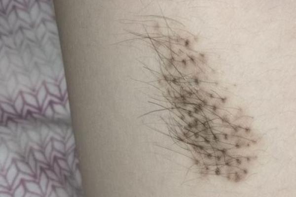 腿上有胎记算命分析