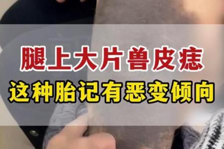 腿上有胎记算命分析
