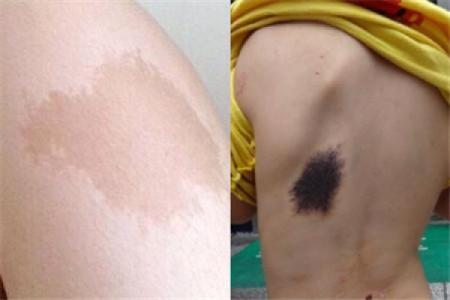 据脖子上胎记算命，有什么说法