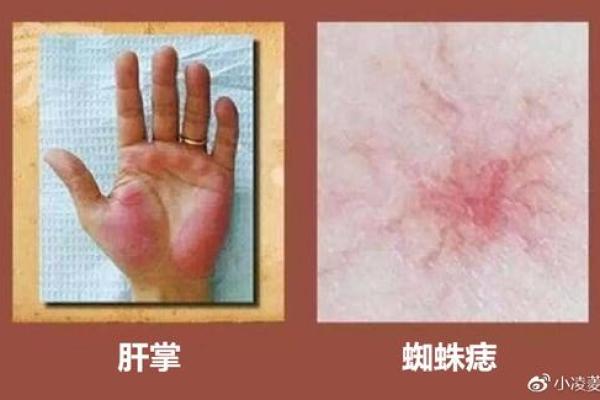 朱砂掌算命，手掌红就是朱砂掌吗？
