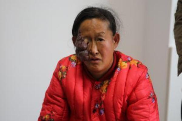 红色胎记算命看危害
