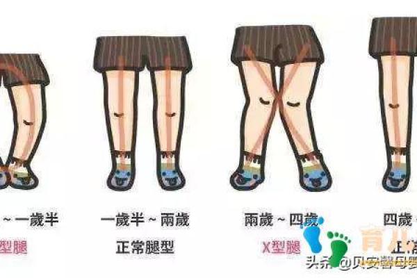 小孩外八字腿
