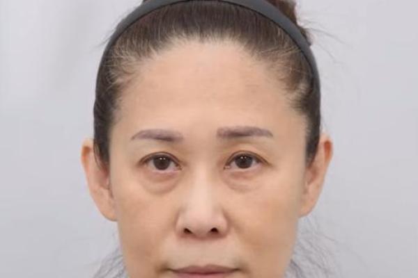 嘴巴八字纹
